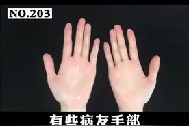 手部经常湿哒哒的，手部多汗影响生活，可以这样处理。#健康科普#多汗症 视频封面
