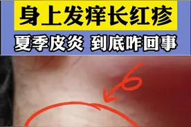 夏季皮炎高发，身上长红疹红斑、痒得难受，试试这样处理#医学科普 #皮炎 #炎热夏季 