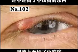 眼睛上长#针眼 ，是不是看了什么不该看的东西，皮肤科医生告诉你#科普 #皮肤 视频封面