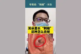 #寻常疣 #刺瘊 长在耳朵里，处理还是#液氮冷冻视频封面