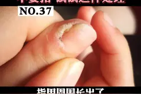 指甲周围长小突起还会脱皮屑，不要自己去扣，容易越长越多。这是#甲周疣 试试这样处理#医学科普 #指甲 视频封面