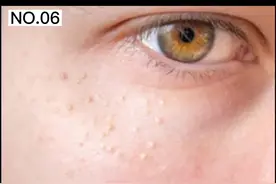 眼睛周围的小白粒，很影响美观，这样子处理#脂肪粒 #皮肤视频封面
