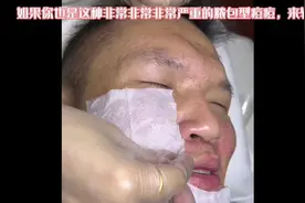 如果你也是这种非常非常非常严重的脓包型痘痘，来找我，免费做。