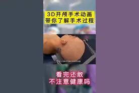 开颅手术带你了解手术过程，看完你还不注意健康吗？#医学科普 #健康科普 #涨知识 #医生 #手术 #开颅 @抖音短视频 @DOU+小助手 