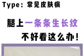 变胖   长高  有宝宝后、身上和腿上就开始出现一条条纹路、很难看、可以这样做！#生长纹 #肥胖纹 #樊哥撩皮肤 视频封面
