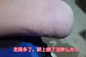 走路多了，脚上磨出来水泡肿么办？看看这硬核处理办法，看着粗暴视频封面