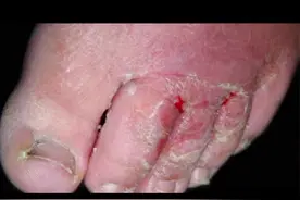 #医学科普 #健康科普 #健康 #分享健康知识 #喜欢就关注我吧 推给你身边脚丫酸臭的朋友们吧。 视频封面