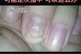 指甲如果出现了这几点变化，要注意了#指甲 #脚趾甲 视频封面