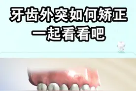 前排牙齿外突是如何矫正的呢？一起看看吧！#dou出新知 #郑州视频封面