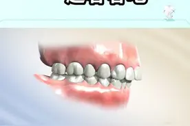 前排牙齿外突是如何矫正的呢？一起看看吧！#dou出新知 #郑州视频封面
