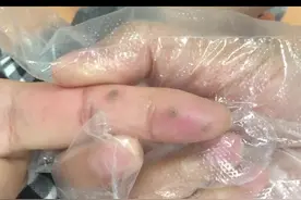 手上反复长疙瘩，用什么方法可以祛除呢？#健康科普 #皮肤管理 #皮肤问题视频封面