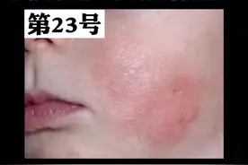 小孩脸上出现对称性的红斑、丘疹。这个是#宝宝湿疹 ，很多宝妈不知道怎么处理，记住这个视频，帮你解决。#医学科普 视频封面