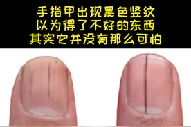 手指甲出现黑色竖纹，别慌，其实它并没有那么可怕。视频封面