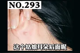耳朵后面长小包，可能是这个原因#科普 #表皮样囊肿 #皮肤 视频封面