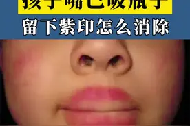 你家小孩会不会也喜欢这么吸瓶子呢，其实这是一个很危险的行为！#小孩子 #医学科普 #紫癜 视频封面