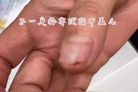 快要过节了，洗鱼洗虾，倒刺儿，异物卡到指甲缝里该咋整？#医学科普 #指甲 #谈骨论今小晖哥 可以照着试试视频封面