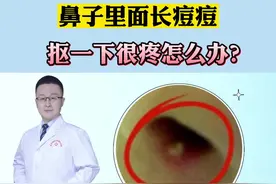 鼻子里面长痘痘，抠一下很疼怎么办？试试这个方法#医学科普 #火疖子视频封面