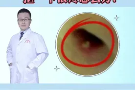 鼻子里面长痘痘，抠一下很疼怎么办？试试这个方法#医学科普 #火疖子视频封面