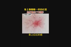 身上出现像蜘蛛一样的#红痣 ，是肝脏出现了问题了吗？#蜘蛛痣 #痣视频封面
