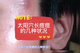 太阳穴长痘痘的几种状况#创作灵感 #敏感肌 #护肤 #痘痘视频封面
