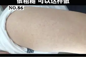 手臂外侧有密集的小红疙瘩，像鸡皮一样粗糙，可以这样做#科普 #鸡皮肤 #粗糙 视频封面