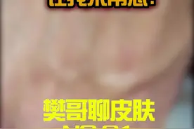 手上有红又痒这么办！希望能帮到粉丝朋友们！@樊哥撩皮肤 #湿疹 #痒 #樊哥撩皮肤 视频封面