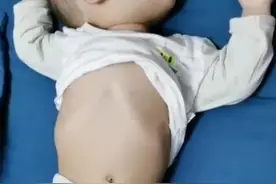 #肋骨外翻 就要给#孩子 #补钙 吗？别盲目补钙害了孩子视频封面