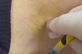 这个肉疙瘩，你想怎么盘它？😬😬😬