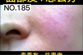 我国花粉过敏人群或超2亿！花粉过敏导致的面部发红瘙痒自救方案！扩散周知#花粉过敏 #春季 #过敏脸 #护肤视频封面