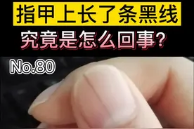 指甲上长了一条黑线，究竟是怎么回事呢？不要自己再在网上乱查，这条视频告诉你 #指甲  #甲母痣  #手视频封面