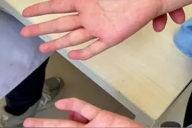 #医学科普 #医路有你 #手指 #小指弯曲 #先天性疾病 @aico视频封面