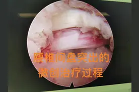 上集腰椎间盘突出患者的微创治疗过程，局麻，内镜下更清晰