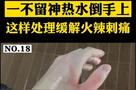 大家日常都会遇到被热水烫伤的情况，这个视频耐心看完，学会处理方法，预防突发情况#烫伤 #烫伤水泡视频封面