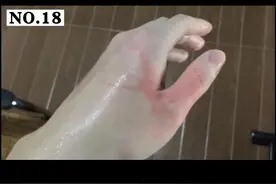 大家日常都会遇到被热水烫伤的情况，这个视频耐心看完，学会处理方法，预防突发情况#烫伤 #烫伤水泡