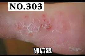 脚底起皮，有裂口，别不当一回事，可能是#脚气#医学科普 #皮肤 