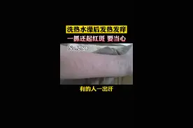 洗热水澡后皮肤发热发痒，一抓还起红斑，#荨麻疹 可以这么办#皮肤 视频封面