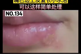嘴边上长这种小水泡，可以这样处理#医学科普 #水泡 #医生 视频封面