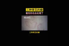 三种常见的癣，看完你也是半个皮肤科医生#股癣 #脚气 视频封面