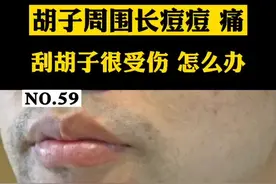 胡须周围长#痘痘 刮胡子的时候经常碰到，超级疼，别担心，一招教你搞定，很简单#医学科普 视频封面
