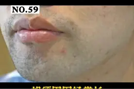 胡须周围长#痘痘 刮胡子的时候经常碰到，超级疼，别担心，一招教你搞定，很简单#医学科普 视频封面