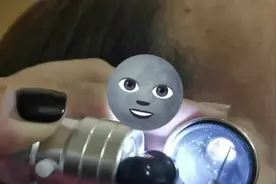 关注耳部健康 耳结石是耳内分泌物长时间沉淀堵塞形成的