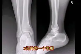 #医学科普 外伤踝关节X片
