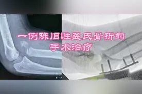 陈旧性孟氏骨折还可以手术治疗吗？#上热门 #医学科普 #骨折视频封面