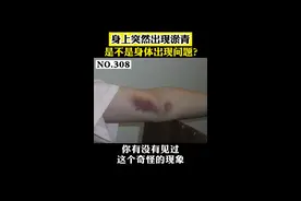 身上突然出现青红色的淤青，是不是身体出现了问题？#医学科普 #科普 #鬼捏青 视频封面