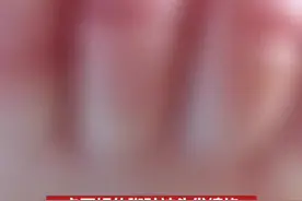 米瑞迪分享这一惊险的往事，是希望提醒所有父母和孩子监护人，多仔细检查环境中是否存在掉落的头发，及时清理。视频封面
