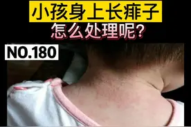 #宝宝身上容易长#痱子 很痒，可以这样处理视频封面