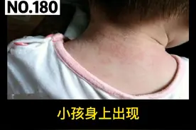 #宝宝身上容易长#痱子 很痒，可以这样处理