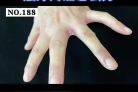 #医学科普指（趾）间潮红糜烂，瘙痒疼痛，可能是念珠菌感染。#健康科普 #皮肤 视频封面