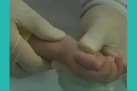 看王医生不做手术给一岁半小朋友按压囊肿#医学科普 #健康科普 @抖音短视频 视频封面