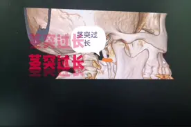 #茎突过长综合征 茎突过长会引起咽痛、咽部异物感等症状，有的还会引起反射性耳痛、头痛和颈痛。正常茎突的平均长度为2.5厘米视频封面